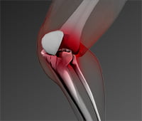 MCL or PCL Knee Injuries