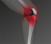ACL Knee Injuries