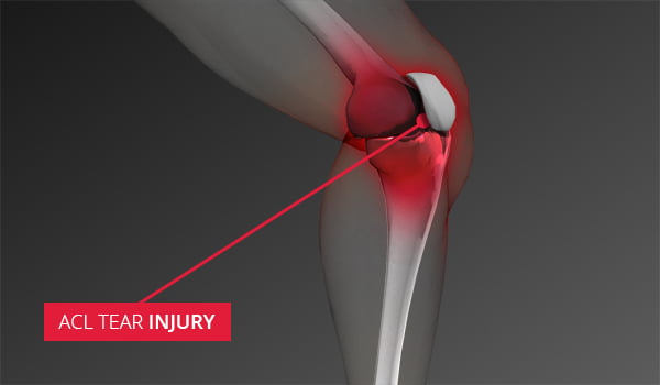 ACL Tear: Symptoms