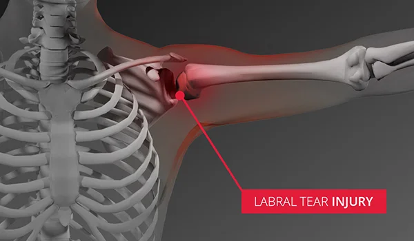 Rotator Cuff Injury & Shoulder Injuries - Sterling Medical Group