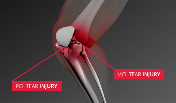 MCl and PCL Injuries