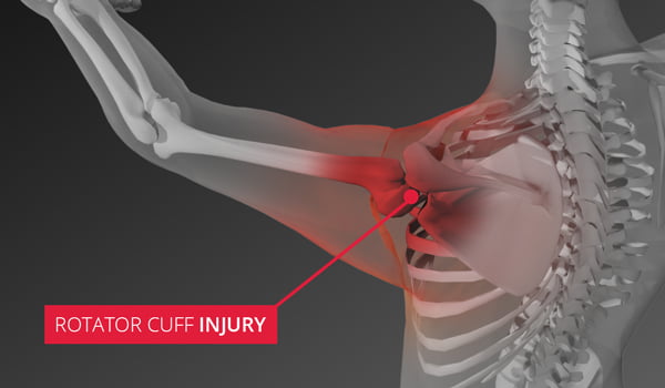 Rotator Cuff Injury & Tear Treatment