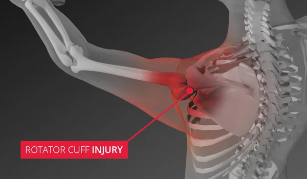 Rotator Cuff Injury & Shoulder Injuries - Sterling Medical Group