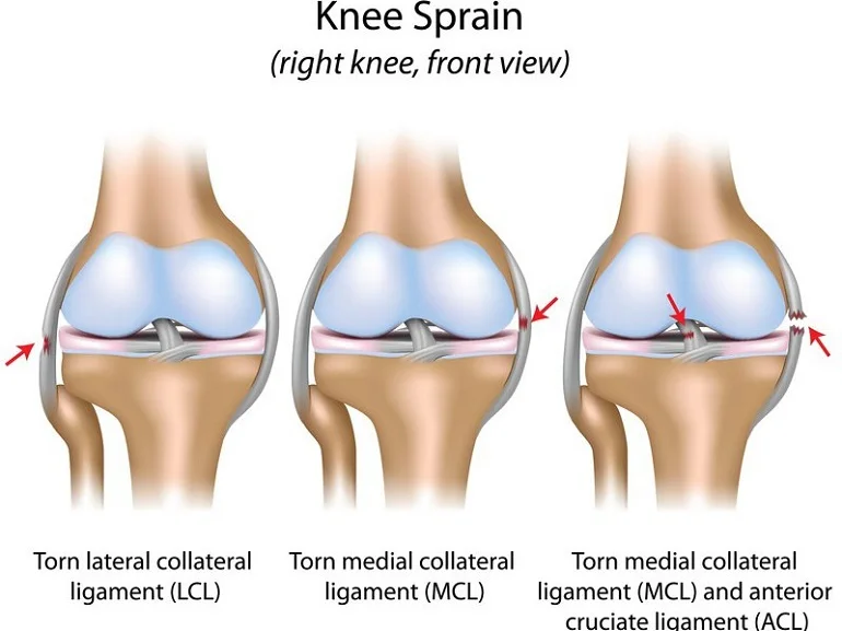 Possible Treatment for Car Accident Knee Injuries - Cooper Schall & Levy