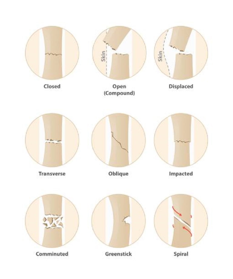 Types Of Broken Bones From Car Crash - Sterling Medical Group