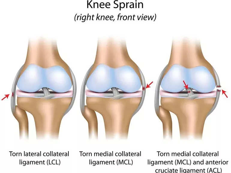 torn acl torn mcl and torn lcl from car accident